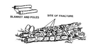Figure 4-7. Improvised blanket and poles splint applied to a fractured leg.