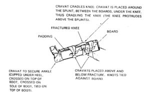 Figure 4-9. Board splint applied to a bent knee.