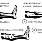 Figure 1-3. Examples of fractures.