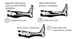 Figure 1-3. Examples of fractures.