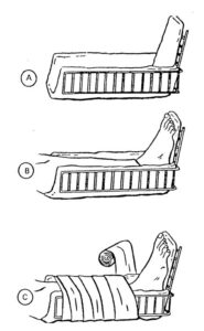 Figure 4-12. Wire ladder splint (three pieces) applied to a fractured ankle.