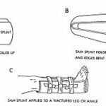 Figure 4-13. SAM splint applied to a fractured ankle.