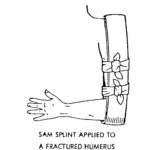 Figure 5-5. Upper arm immobilized using a SAM splint.