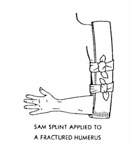 Figure 5-5. Upper arm immobilized using a SAM splint.