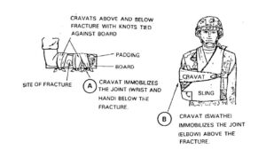 Figure 5-7. Improvised splint applied to a fractured forearm.