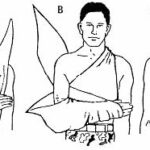 Figure 5-9. Applying a triangular bandage sling (arm sling number two).