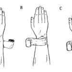 Figure 6-2. Applying an anchor wrap.