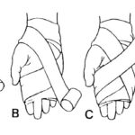 Figure 6-6. Applying a figure-eight wrap.