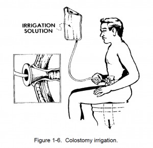 Colostomy Irrigation
