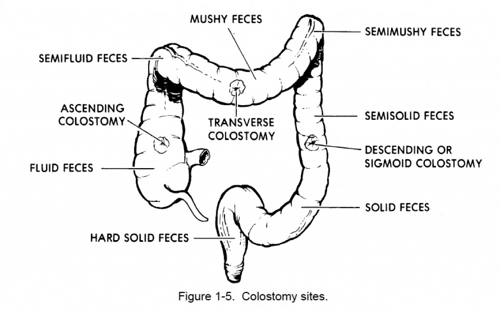 1-43-colostomy-nursing-care-related-to-the-gastrointestinal-and