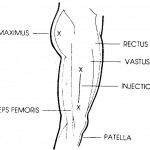 Figure 2-3. Location for thigh injection.