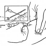 Figure 2-7. Insertion of needle.