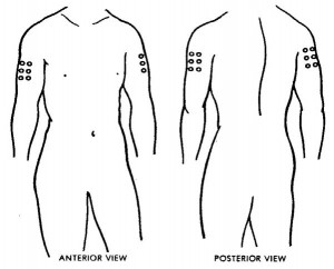 Figure 2-8. Deltoid area of shoulder, outer aspect of upper arm. 