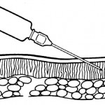 Figure 2-11. Position of needle. Proper angle and depth for an intradermal (ID) injection.