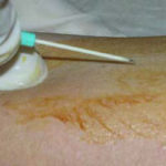 Figure 1-10. Performing venipuncture.