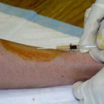 Figure 1-11. Conducting venipuncture.