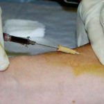 Figure 1-12. Using pressure to limit bleeding