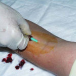 Figure 1-13. Connecting the IV tubing