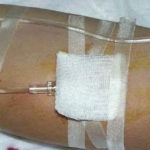 Figure 1-14. Dressed and taped IV (when time permits)