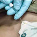Figure 1-19. Connecting the infusion tube