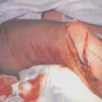 Figure 1-2. Significant wound to the leg.
