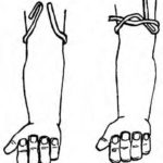 Figure 2-3. Constricting band