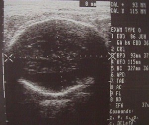 Fetal biparietal diameter and frontal-occipital diameter.