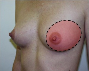 Cyclic breast pain is usually most prominent in the upper, outer quadrant, and in the areolar areas.