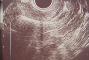 Ultrasound scan showing a Copper T IUD positioned normally in the fundus.