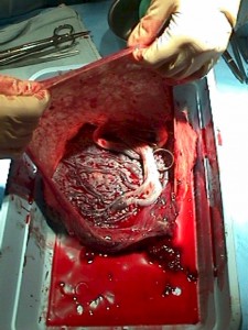 After delivery, inspect the placenta for completeness and abnormalities.