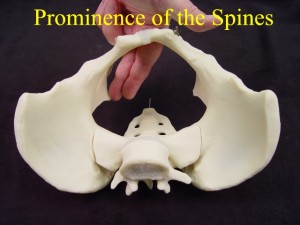 Prominence of the Ischial Spines