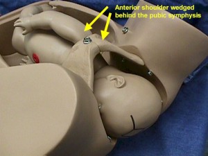 Shoulder Dystocia with the fetal shoulder trapped behind the pubic bone.
