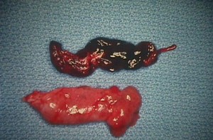 Ectopic removed by salpingectomy
