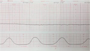 Bradycardia (85-95 BPM)