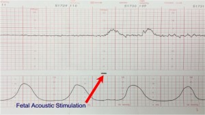 Fetal Acoustic Stimulation with normal fetal heart response