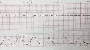 Tachysystole (6 contractions in 9 minutes)