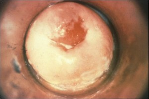 Gonorrheal cervicitis