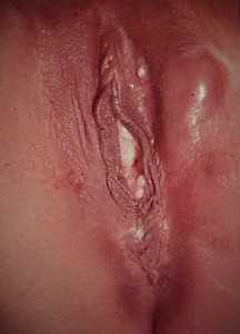 Lymphogranuloma Venereum (LGV)