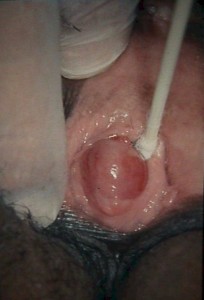 Skene's gland abscess