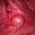 inclusion cyst of the vulva
