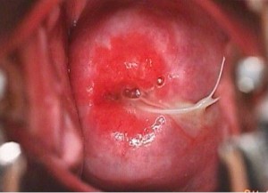IUD string visible at the cervical os