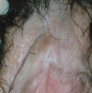 Lichen Sclerosis around the clitoral hood, showing whitish discoloration of the skin and loss of anatomic detail