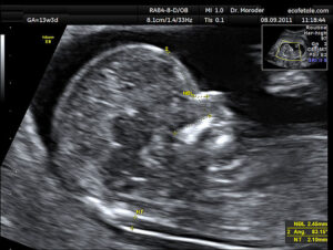 Nuchal Translucency - Provided by Wolfgang Moroder via Wikimedia Commons, and the Creative Commons Attribution-Share Alike 3.0 Unported license.