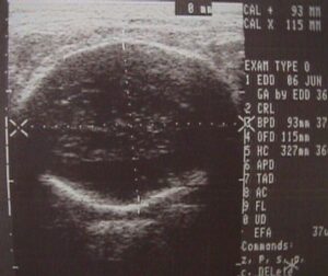 Two dimensional ultrasound