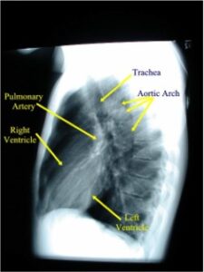Normal Lateral Chest X-ray