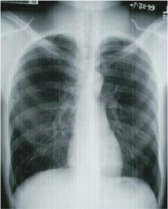 Normal Posterior to Anterior (PA) Chest X-ray