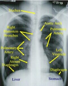 Normal Posterior to Anterior (PA) Chest X-ray
