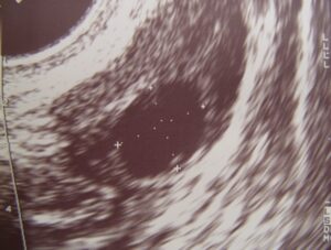 Normal Ovarian Follicle