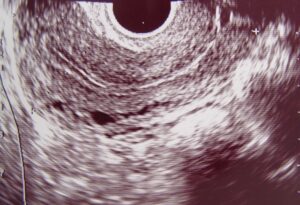 Normal Uterus, Sagittal View