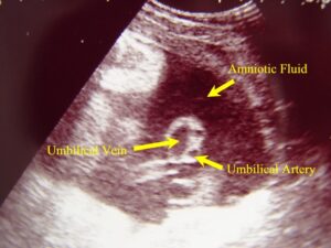 Umbilical Cord in Cross Section